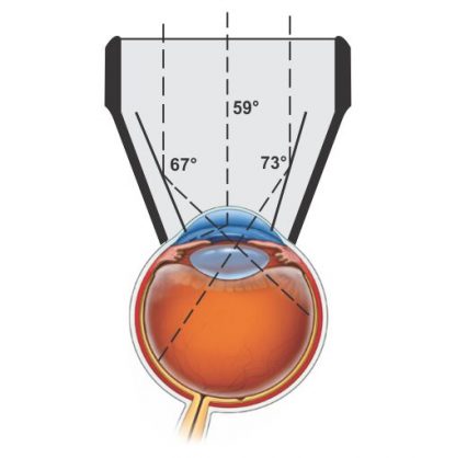 YAG Capsulotomy