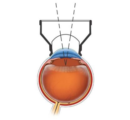 YAG Capsulotomy