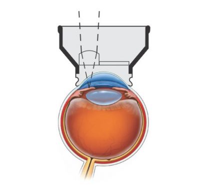 YAG Iridectomy